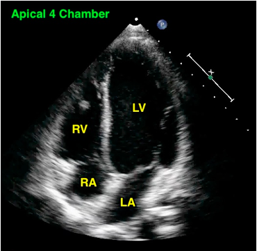 Эхо 4. Apical 4 Chamber. Apical four-Chamber view. Apical 5 Chamber view Echocardiogram. Apical 3 Chamber view.